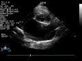 A severely enlarged left atrium in a cat with severe hypertrophic cardiomyopathy and resultant left heart failure.