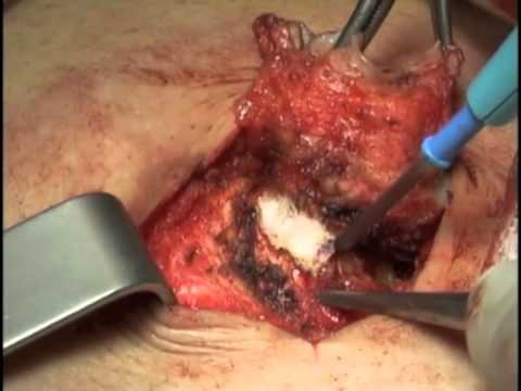 how to treat omphalitis