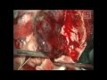 MENINGIOMA BRAIN -right temporo- parietal region-microsurgical removal in toto-dr suresh dugani