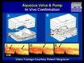 Pulsatile Aqueous Outflow