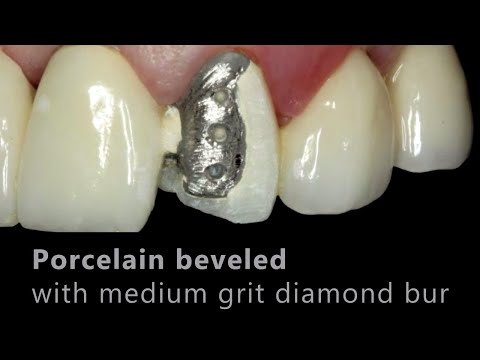 how to repair pfm crown