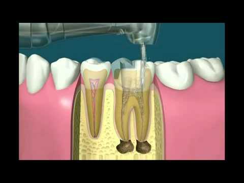 how to whiten teeth if you have fillings