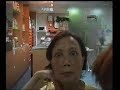 Goiter minimization under Thyroid Throu - Case6 before