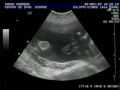 Fabian a sus 27 semanas Fabian a sus 27 semanas
