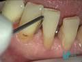 trattamento non chirurgico parodontite microscopio laser non surgical treatment of periondotitis