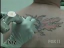 Blake Lewis Removes Tattoo with MedLite Laser Blake Lewis Removes Tattoo with MedLite Laser
