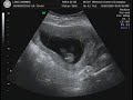 12 weeks 1 day Ultrasound