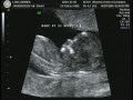 12 weeks 1 day Ultrasound