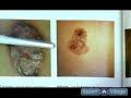 Sunburn Relief & Skin Care Tips : Melanoma Skin Cancer Symptoms