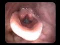 EndoscopeRepair.com Endoscope View of Voice box trachea