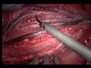 Harmonic Scalpel in action Harmonic Scalpel in action