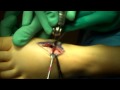 Dr. Patrick A. DeHeer, DPM - Lapidus Arthrodesis Part 2 of 3