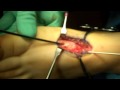 Dr. Patrick A. DeHeer, DPM - Lapidus Arthrodesis Part 2 of 3