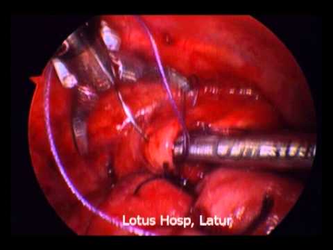 Thoracoscopic CDH repair by Dr. Sanjay Poul Patil, Lotus Hospital Latur.wmv