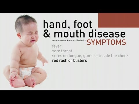 how to treat hfmd in babies