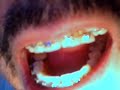 orthodontics gold braces