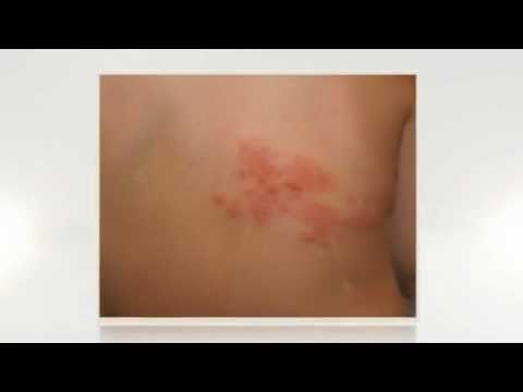 how to treat shingles