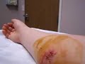 Ninja Battle Wound