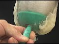 Prosthetic Socket Refinement With Renew Silicone Replicator