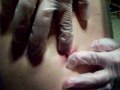 zit abcess cyst???whopper explosion on back