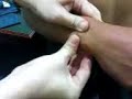 Distal Radioulnar Joint Subluxation / Dislocation Distal Radioulnar Joint Subluxation / Dislocation