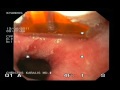 Radiofrequency Ablation Of Halo 90 Method After Endoscopic Mucosal Resection Of Cancerous Nodule. Radiofrequency Ablation Of Halo 90 Method After Endoscopic Mucosal Resection Of Cancerous Nodule.