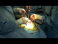 Protesis de Cadera - Hip Surgery Protesis de Cadera - Hip Surgery