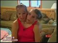 Siamese Twin Girls