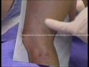 Spider Veins Radnor Dr Kirksey Penn Presbyterian