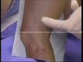 Spider Veins Radnor Dr Kirksey Penn Presbyterian