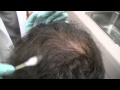 Alopecia areata: hair loss treatment and patient stories