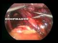 Laparoscopic Repair of Paraesophageal Hiatal Hernia w/ Pancreas