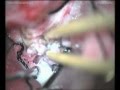Sphenoidal wing meningioma - Left pterional approach