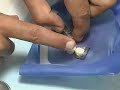 amalgam-carve