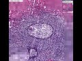 Histopathology Ovary--Brenner tumor Histopathology Ovary--Brenner tumor