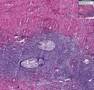 Histopathology Ovary--Brenner tumor