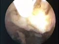 ABLA��O DO ENDOMETRIO COM MIOMECTOMIA