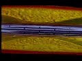 stent for opening up clogged artery