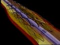 heart stent