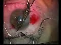 Fish Hook Eye Surgery