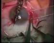 Fish Hook Eye Surgery (Not my Eye)