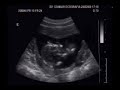 1� Ultra do Baby - Juliana e Marcos