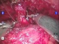 Reconstruction Of The Sphincter After Robot-Assisted Radical Prostatectomy Reconstruction Of The Sphincter After Robot-Assisted Radical Prostatectomy