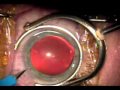 Cataract Surgery with Akahoshi Pre-chopper.mpg