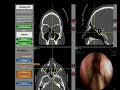 Revision left sided sinus procedure with computer assistance and a shaver instrument