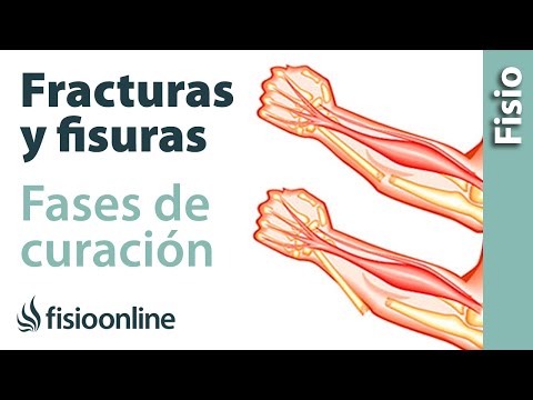 Fractura y fisura - Qué es y cuáles son sus fases de curación.