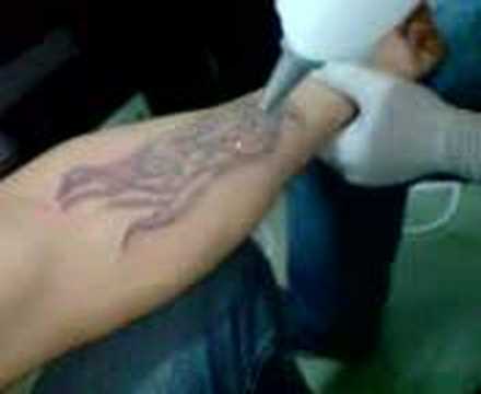 Removing of TATTOO by Laser Removal DONT Make a Tattoo befor THINKING !