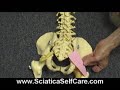 What Causes Sciatica? What Causes Sciatica?