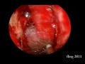 Intranasal Encephalocele Endoscopic Resection