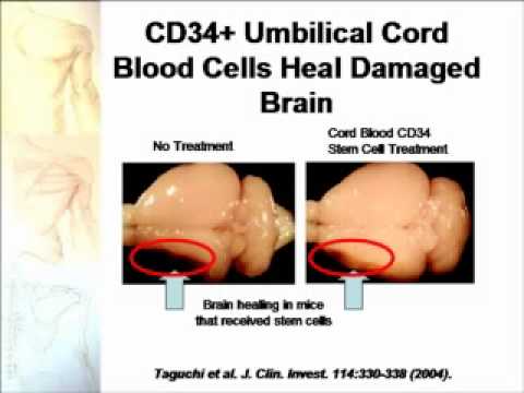 STEM CELLS – Therapy for Autism (Balzitt).flv